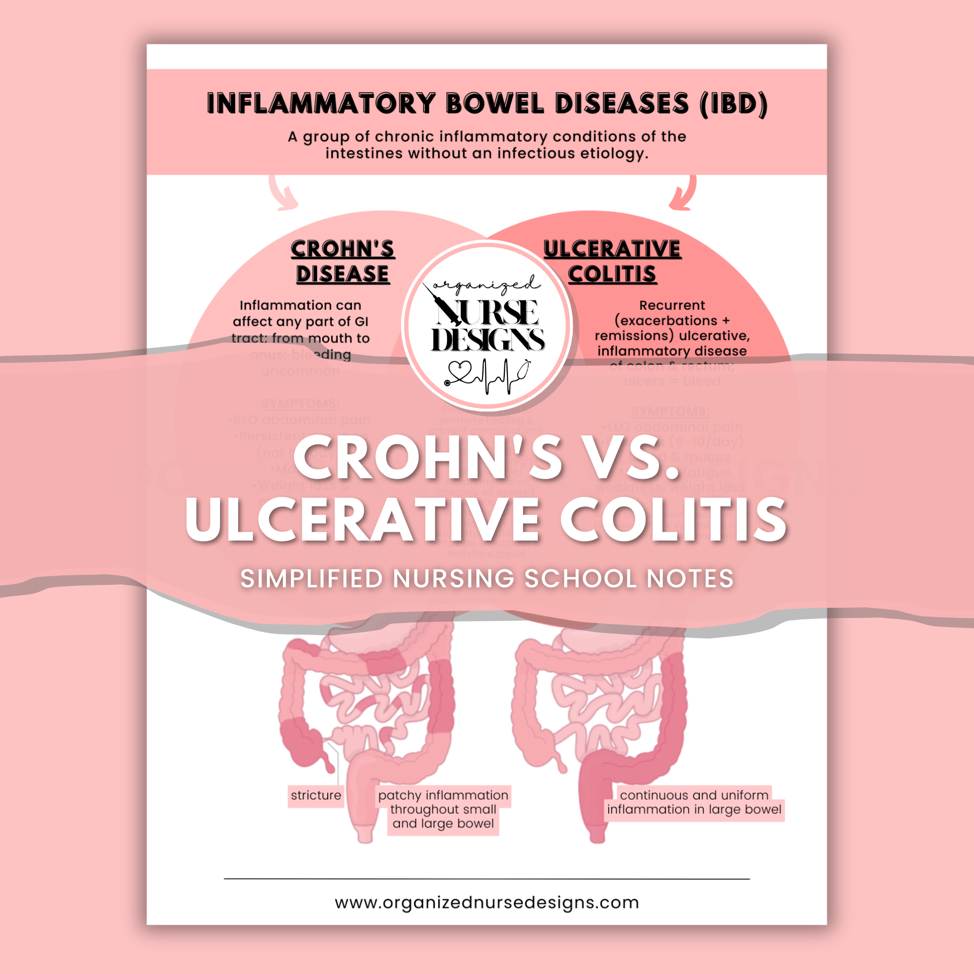 Crohn's vs. Ulcerative Colitis Nursing Study Guide – OrganizedNurseDesigns